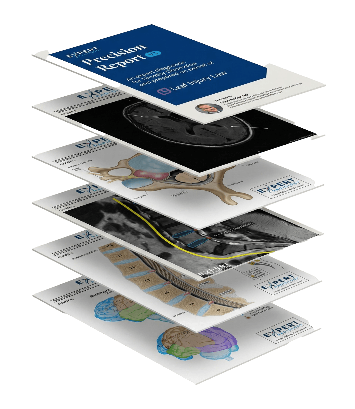 PrecisionPlus v3 stacked report pages showing various MRI visualizations and annotated medical imagery